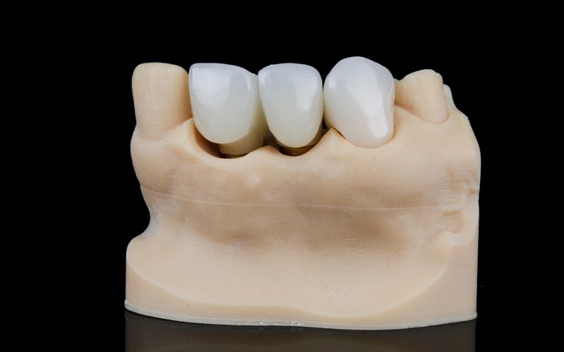 3-Unit Dental Bridges