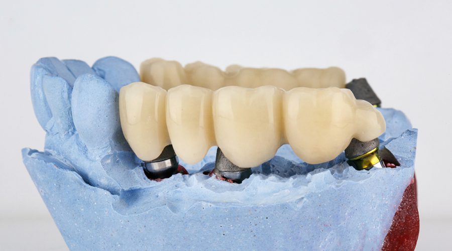 dental implant bridge