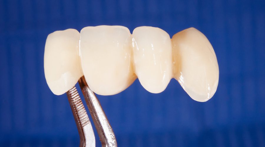 Porcelain Bonded Bridge