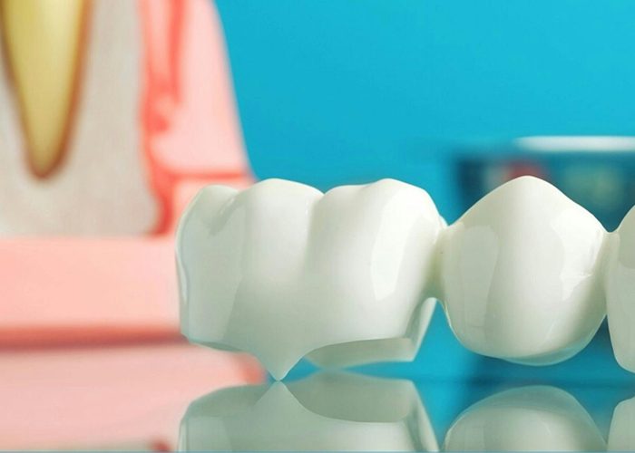 dental bridges in turkey