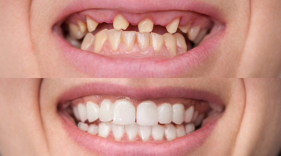 Dental Implant Bridge in turkey