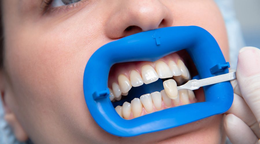 gummy smile correction turkey