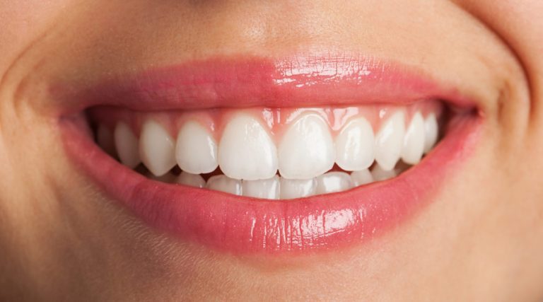 affordable smile makeover