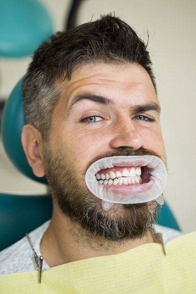 low cost dental implants