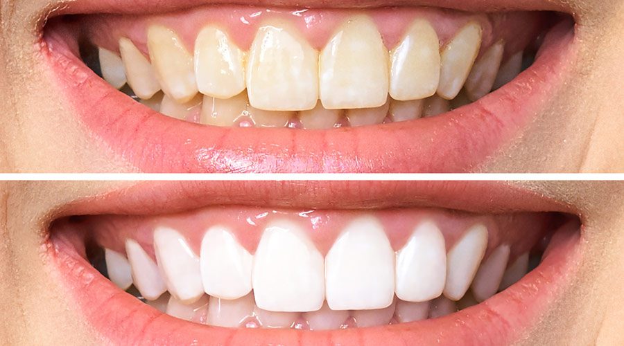 smile makeover without braces