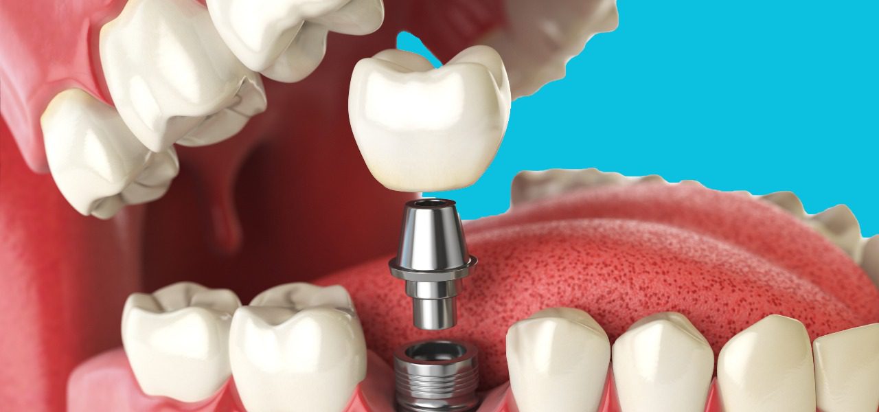 Dental Crowns in turkey