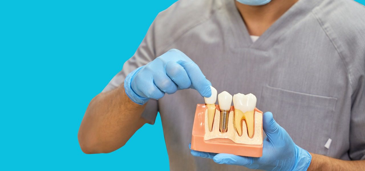 Dental Implants for a Complete Smile Makeover