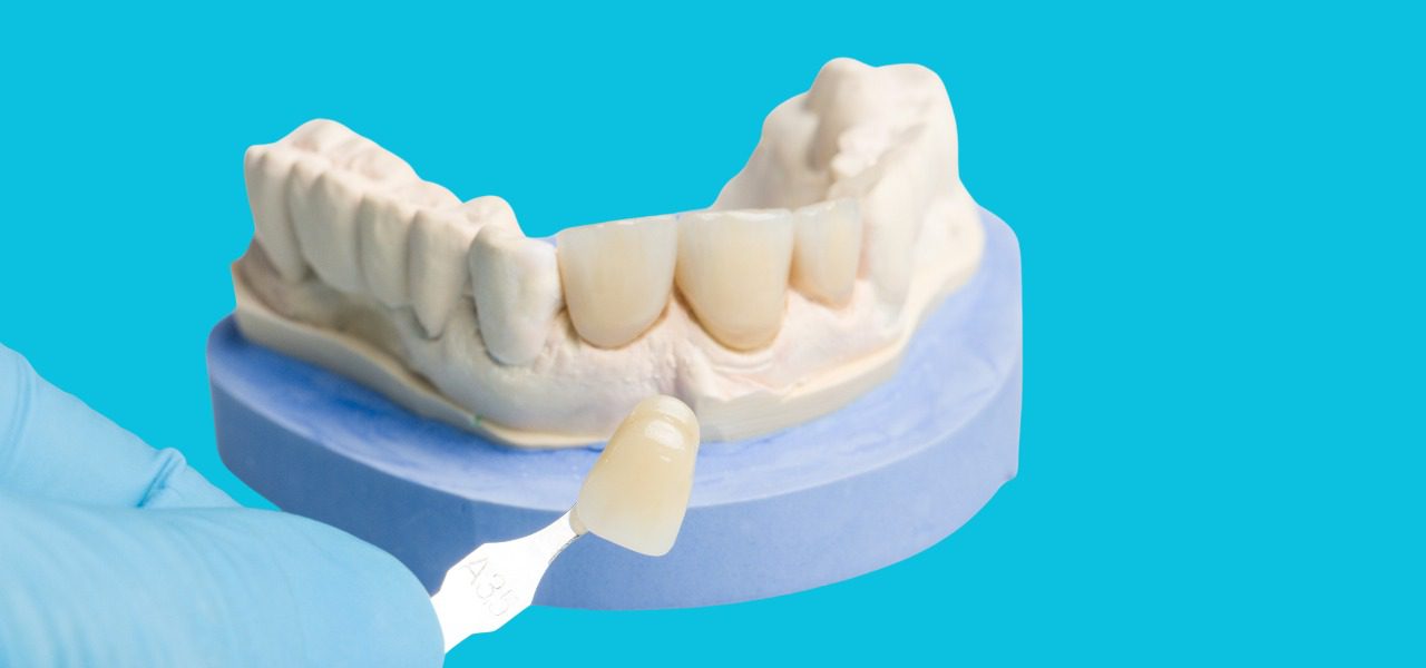 Dental Veneers in turkey