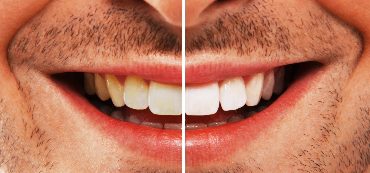 Hollywood Smile in Turkey