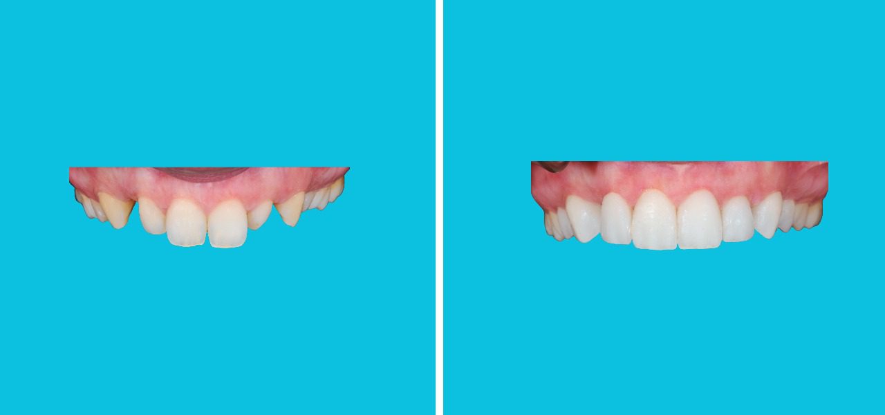 Invisalign treatment in turkey