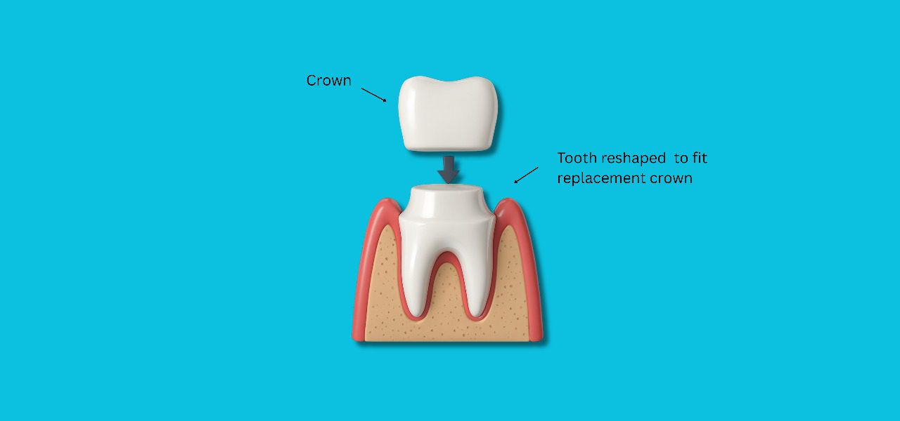 NHS Crowns vs Private Crowns