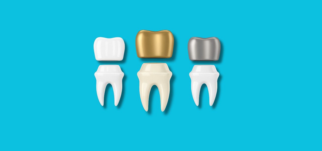NHS Dental Crowns in the UK