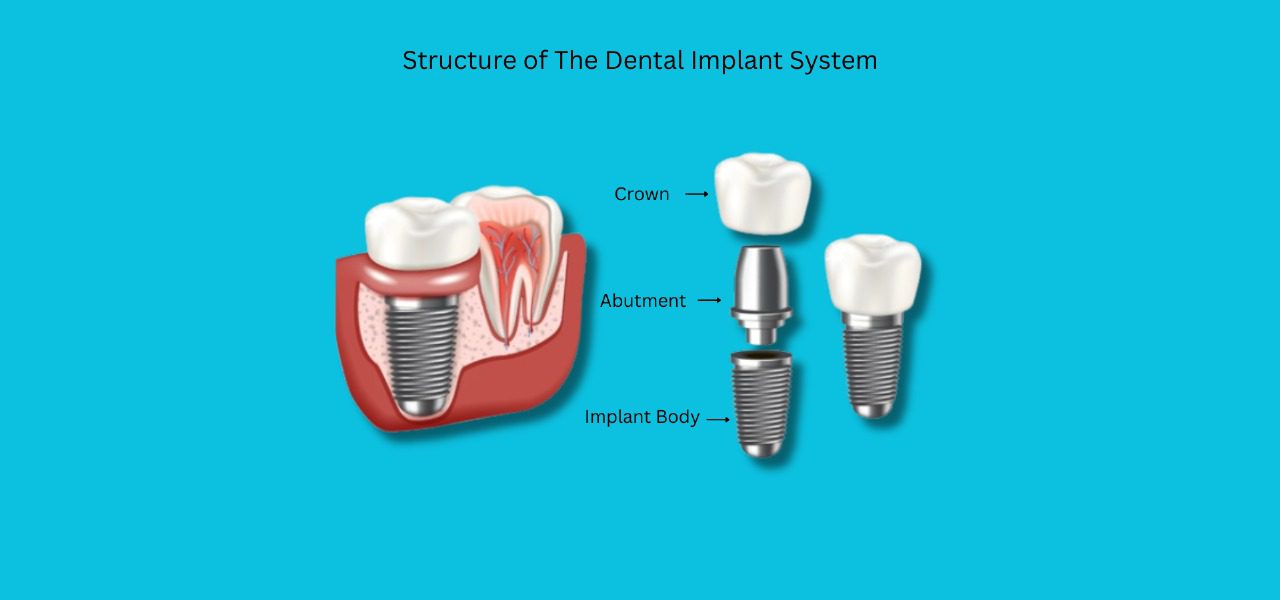 Structure of dental implants system
