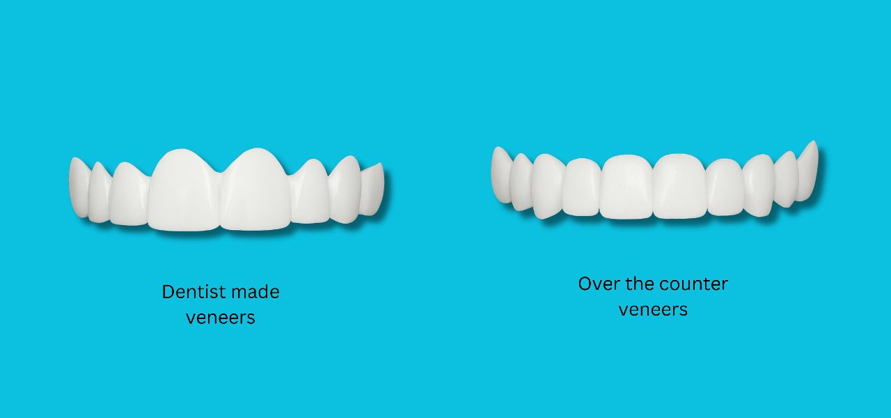 Types of Snap-on veneers