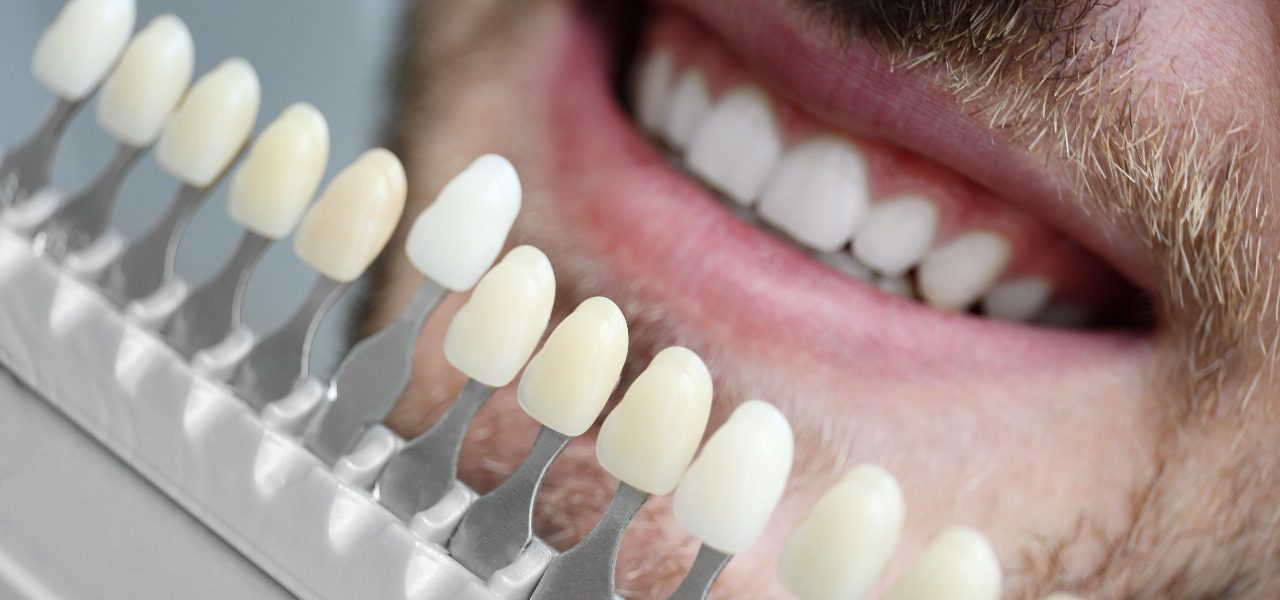 What are dental veneers and how much do they cost