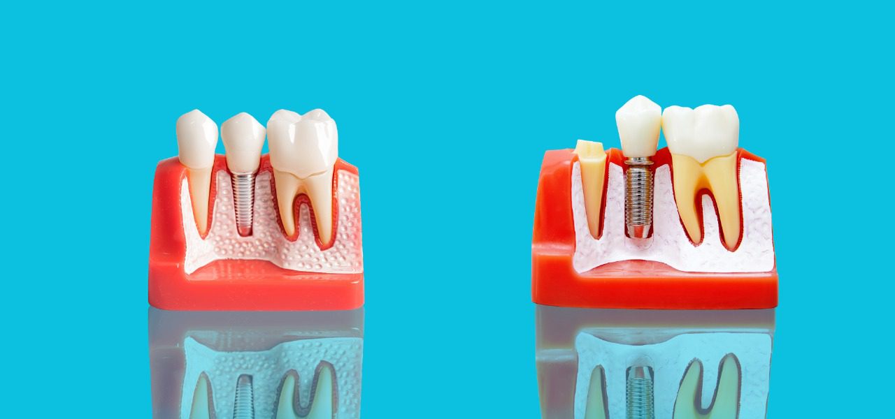 Dental Implants in Turkey 