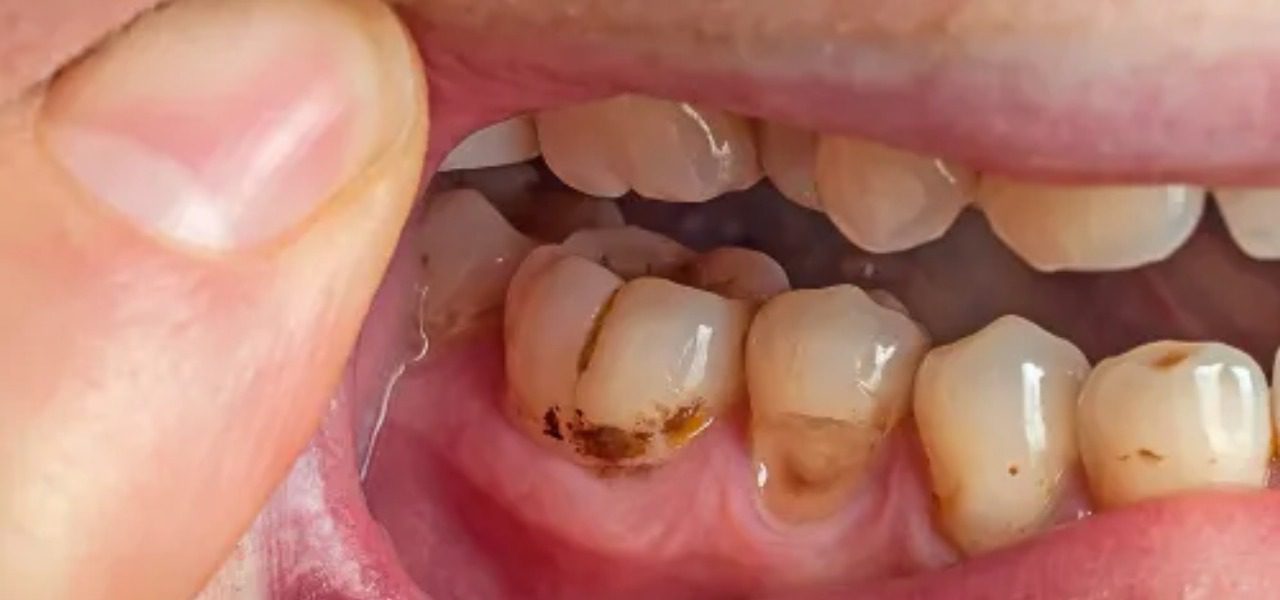 a picture of someone with tartar, and teeth discoloration