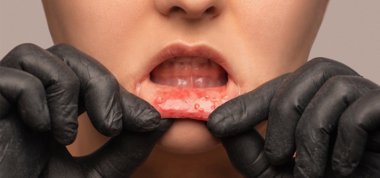 Aphthous (Canker Sores)