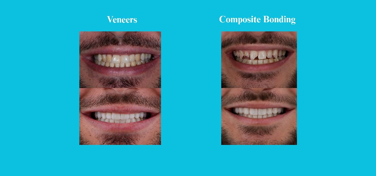 Bonding vs veneers pictures