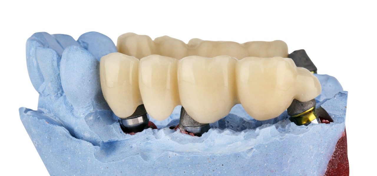 Dental Bridges in uk