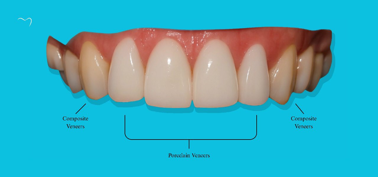 Porcelain bonding vs veneers pictures