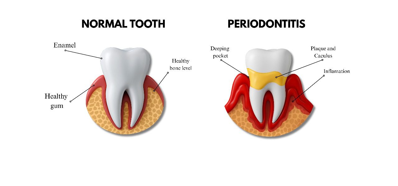 Early Periodontitis