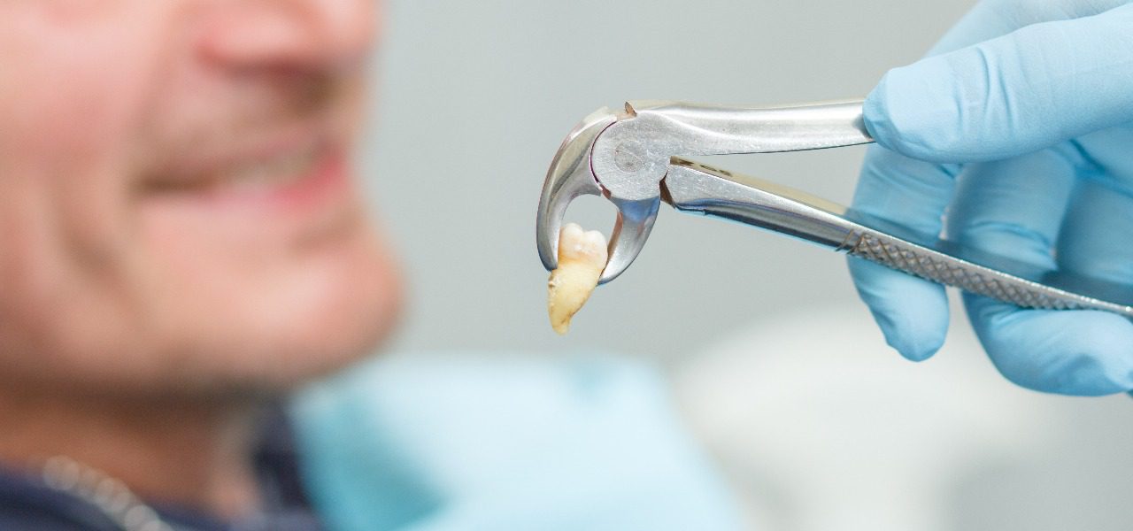 Full Mouth Extraction with Dentures