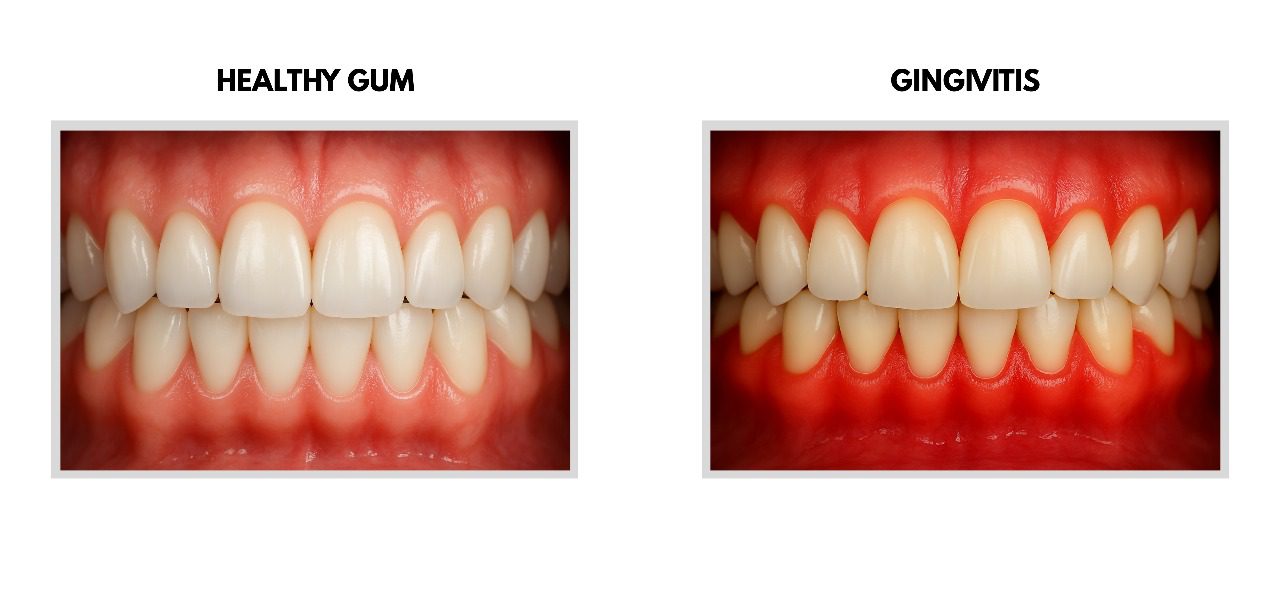 Gum diseases