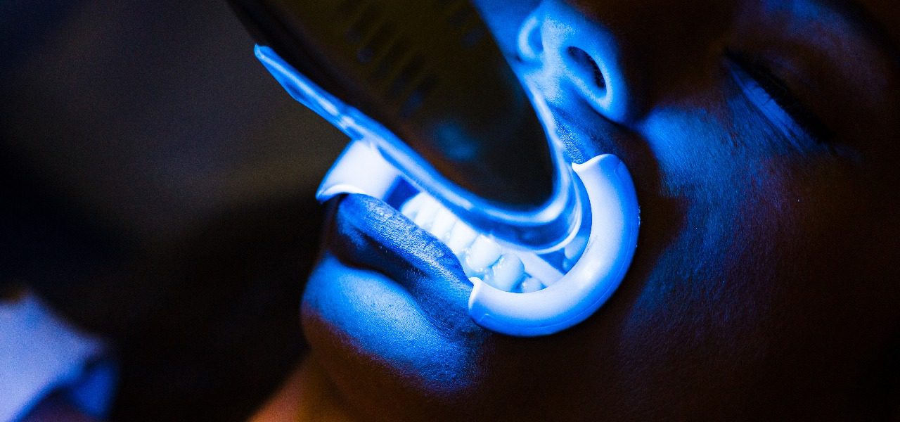 Professional Whitening