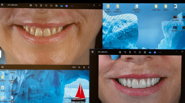 true story dental teeth in turkey