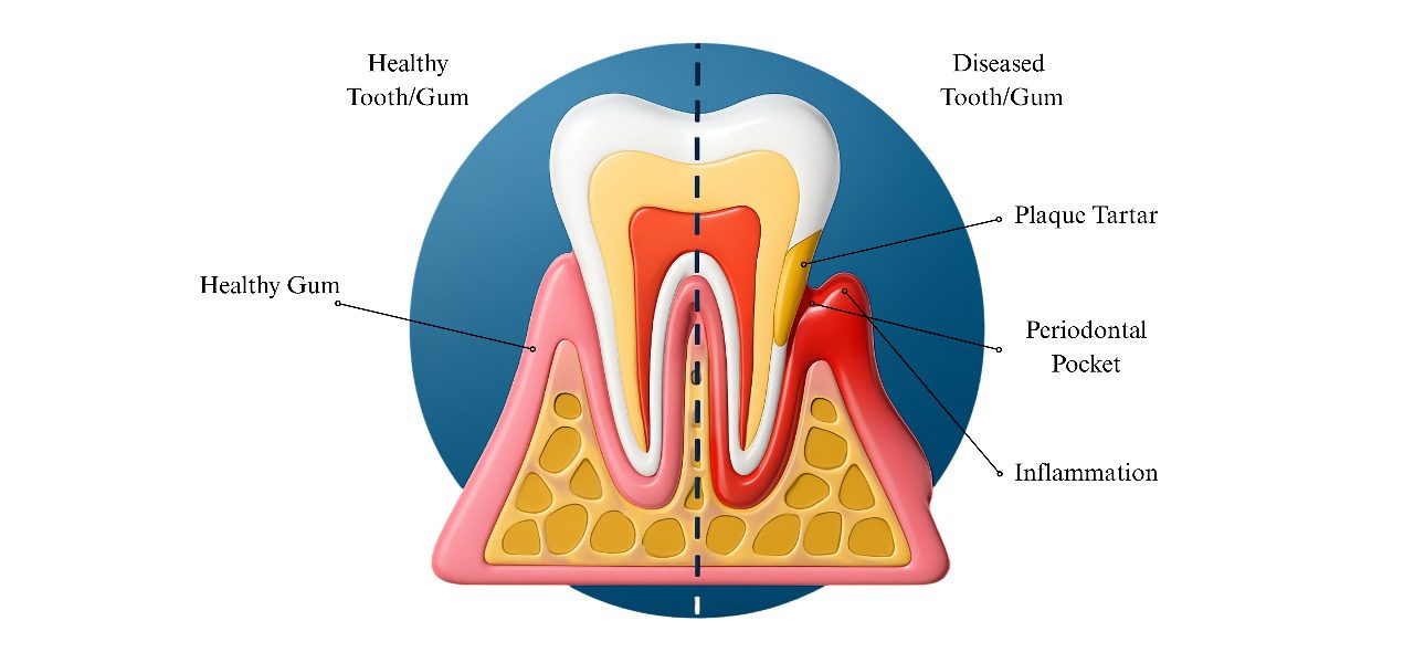 Stage 3 Moderate Periodontitis.