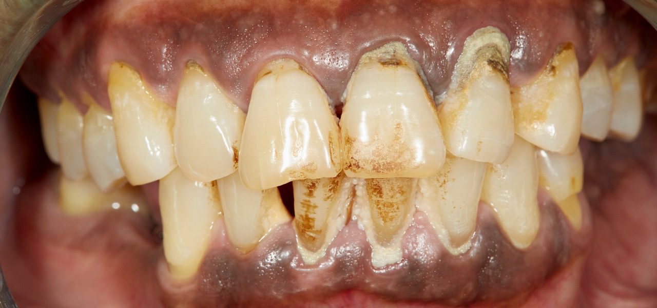 Stage 4 Advanced Periodontitis