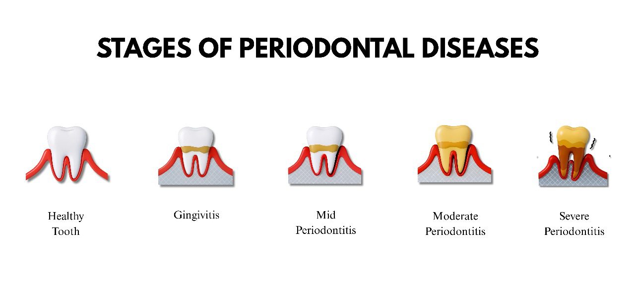 Stages of Periodontitis