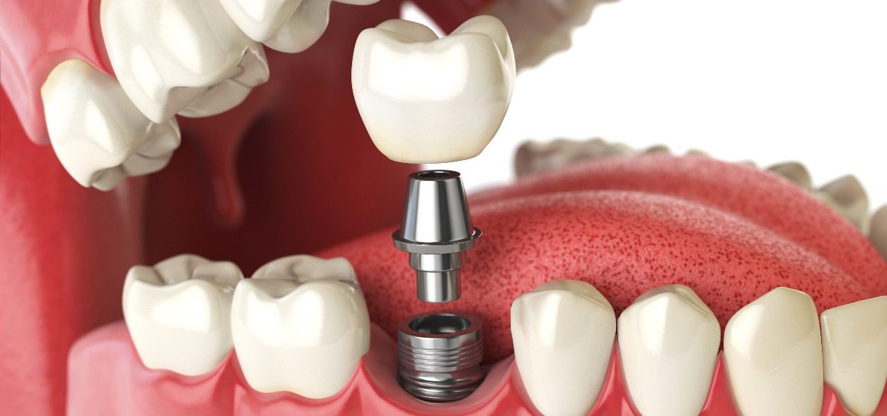 Tooth Extraction in uk