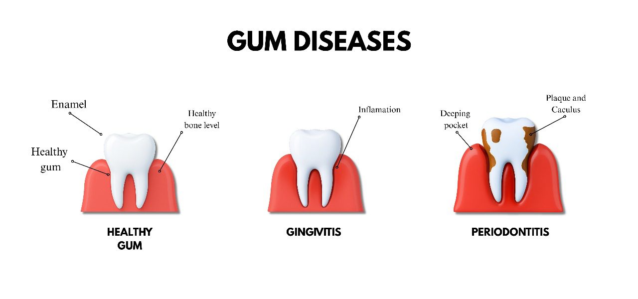 Understanding Gum Disease