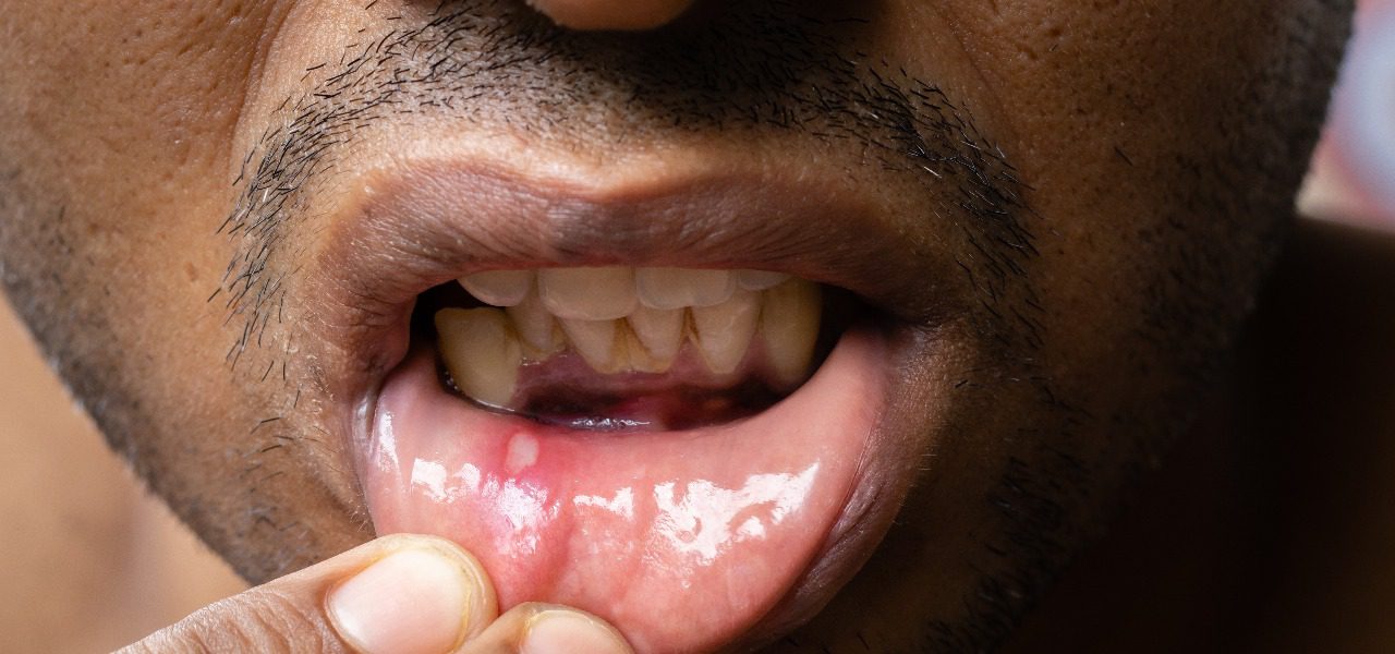 What Are Mouth Ulcers