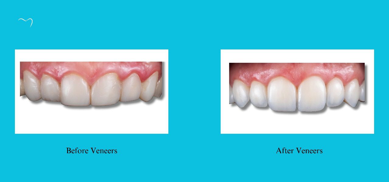 While this is a before and after picture of veneers