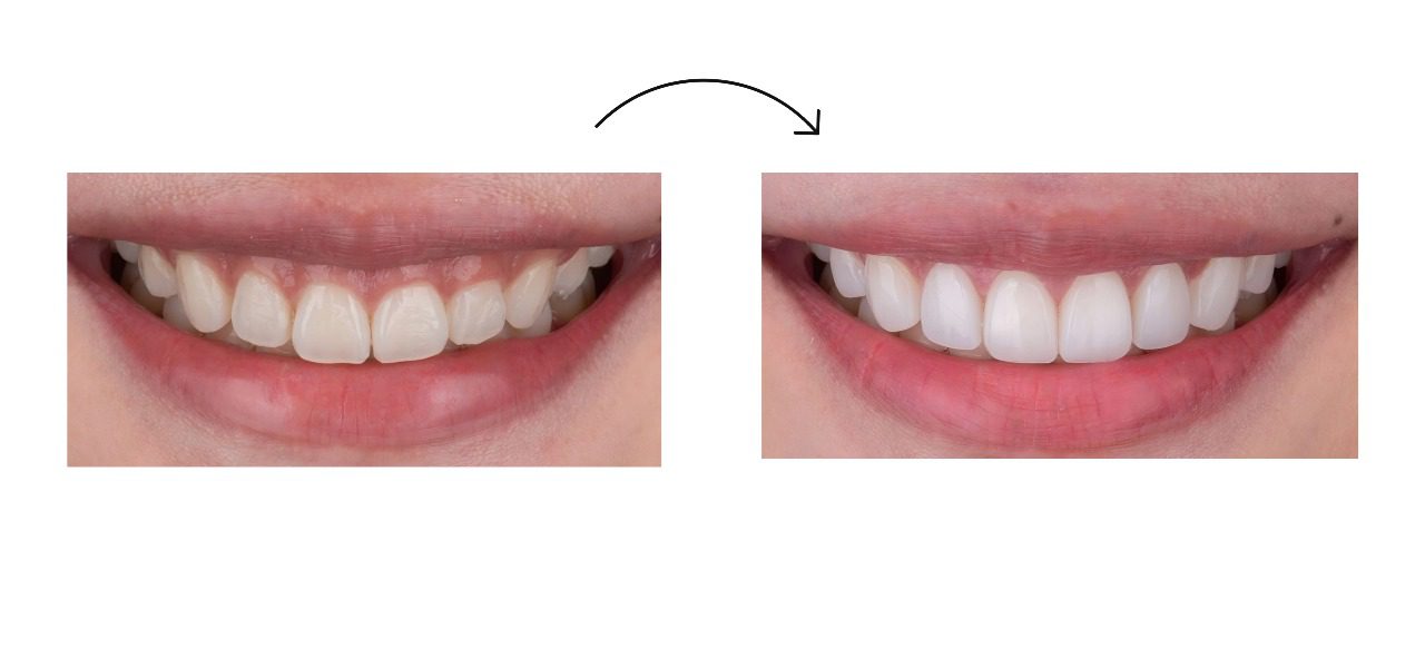 dental veneers before and after