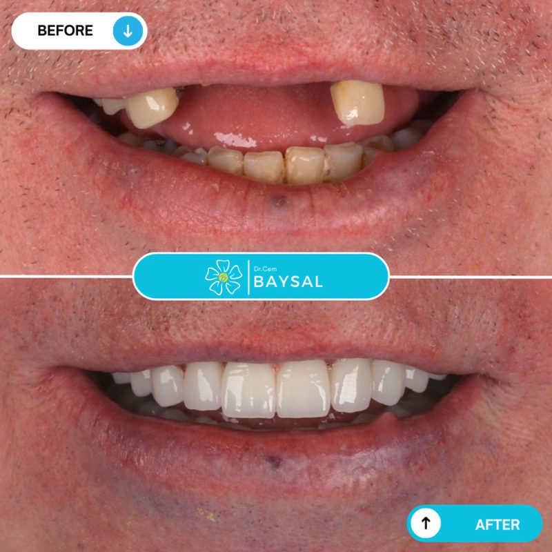 Turkey teeth before and after displaying replacement of missing and damaged teeth.