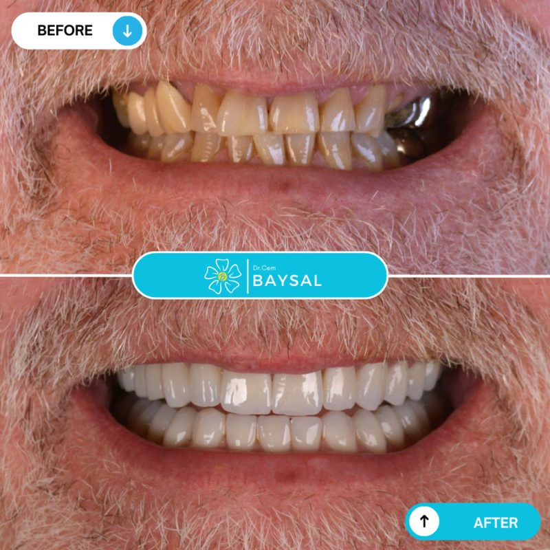 Turkey teeth before and after with full smile restoration from worn teeth
