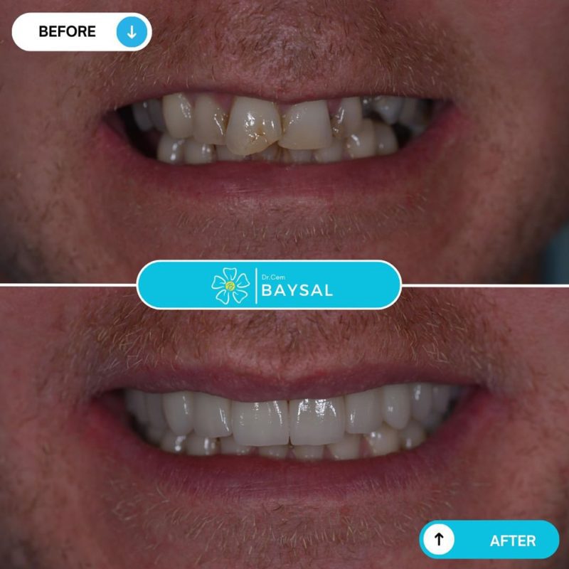 Turkey teeth before and after showing dramatic smile enhancement.