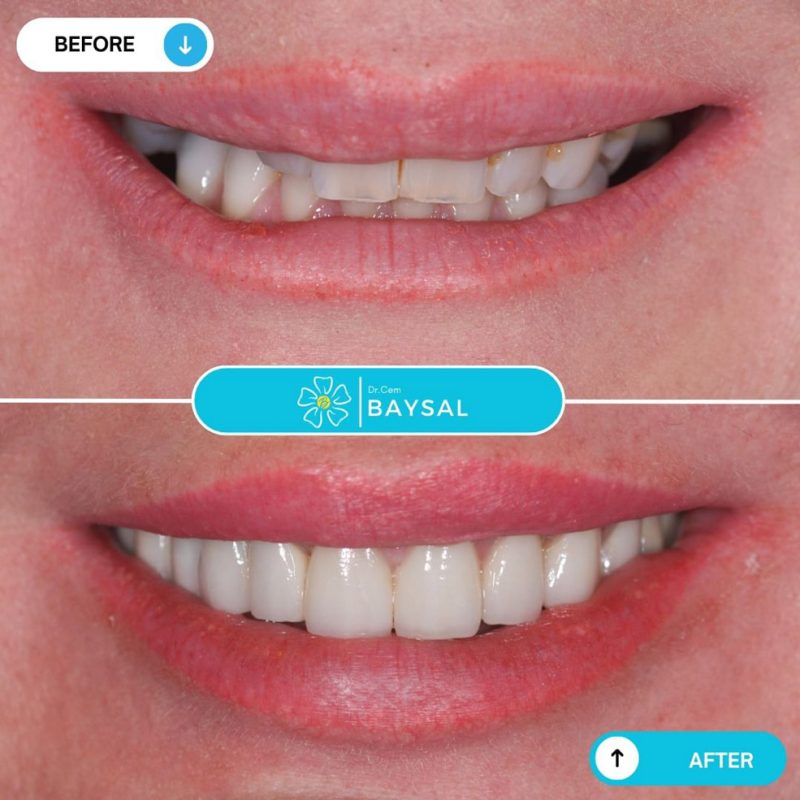 Turkey teeth before and after featuring whiter, perfectly shaped veneers.