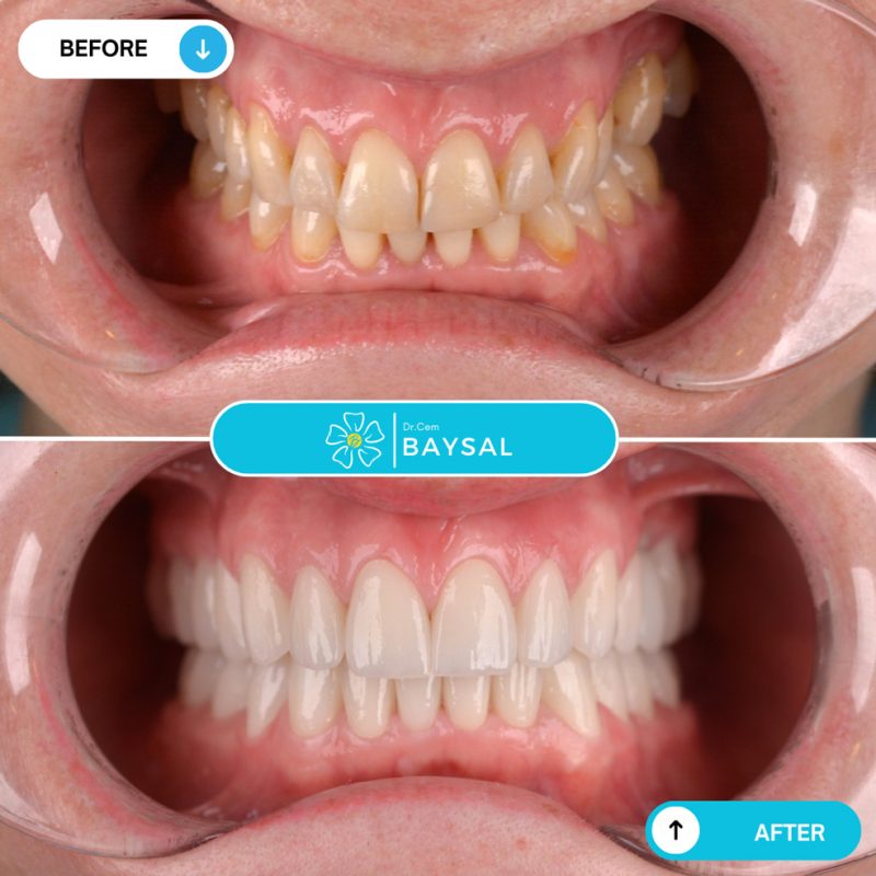 Close-up Turkey teeth before and after with improved colour and alignment