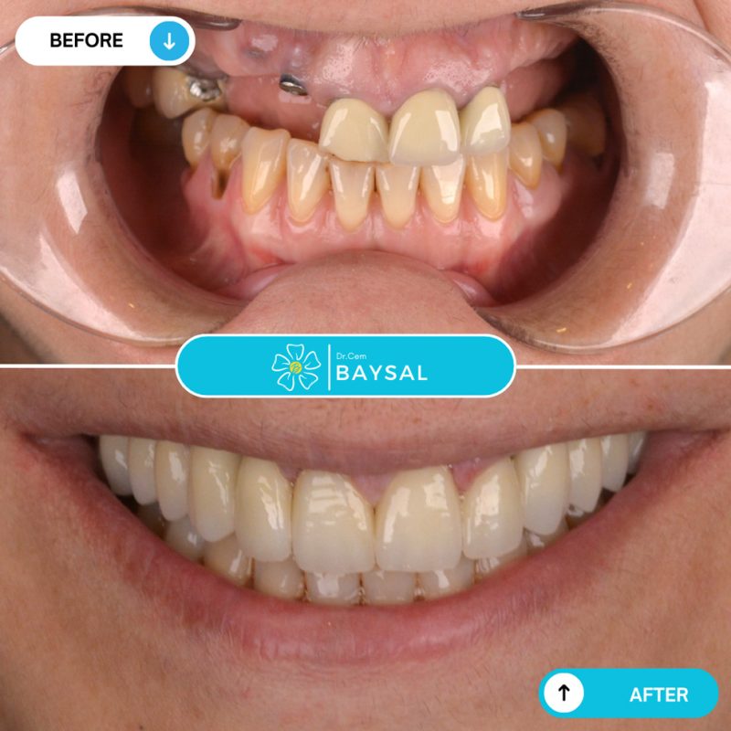 Turkey teeth before and after showing transformation from yellow, uneven teeth to bright, aligned smile.