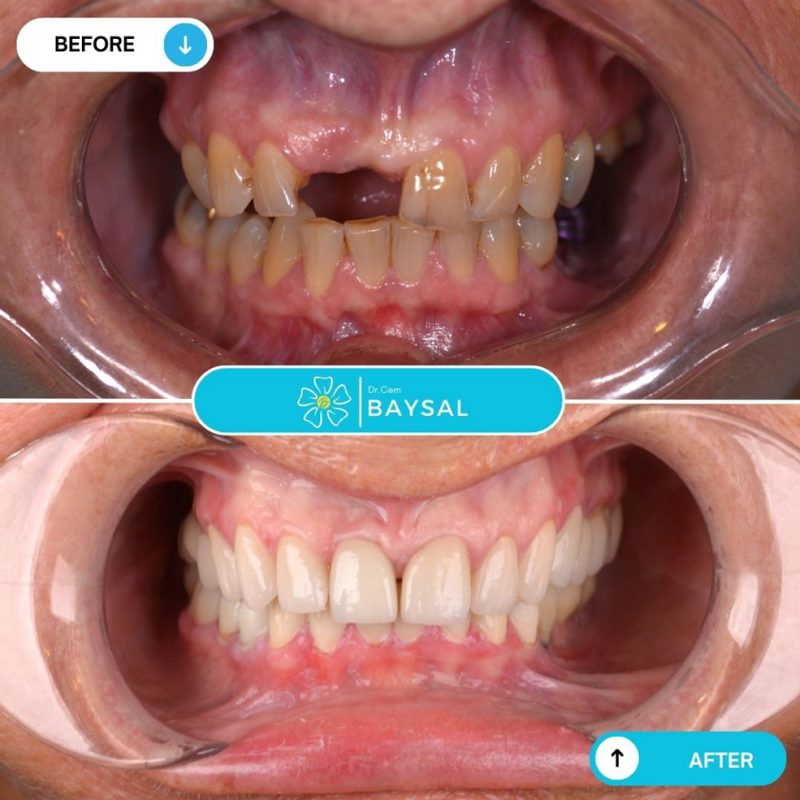 Turkey teeth photos before and after showing improved gum health and whiteness.
