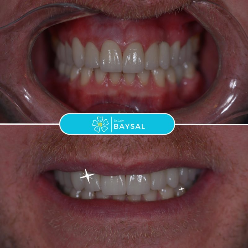 turkey teeth veneers before and after