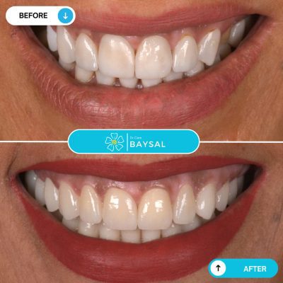 Turkey teeth before and after transformation to natural-looking, straight smile.