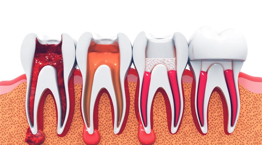 Root Canal