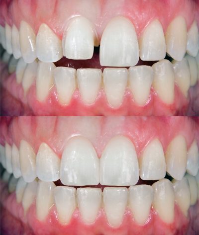 bonded non precious crown