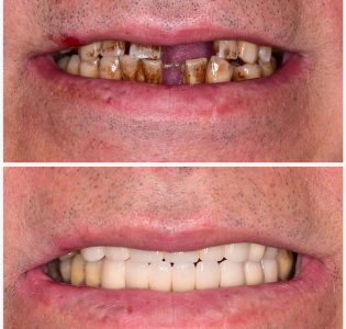 dental implants turkey